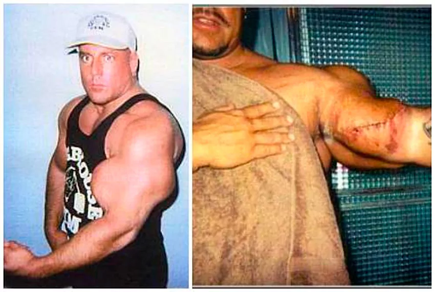 gregg valentino with abscess on one of his biceps